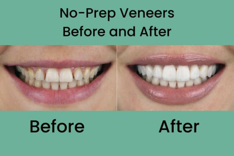 Pros And Cons Of NoPrep Veneers What You Should Know BEFORE You