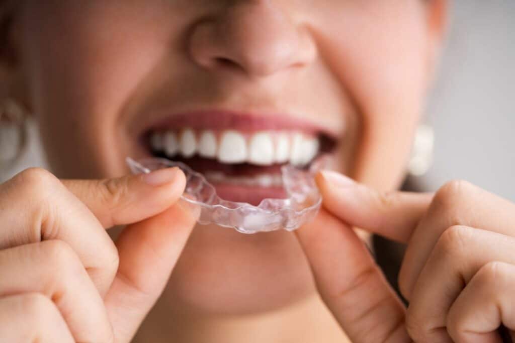 Byte vs. Invisalign: Everything You Need to Know BEFORE You Choose ...