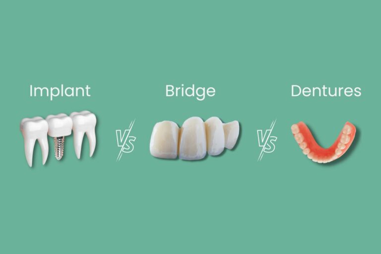 Dental Implant Alternatives: Think About These! 