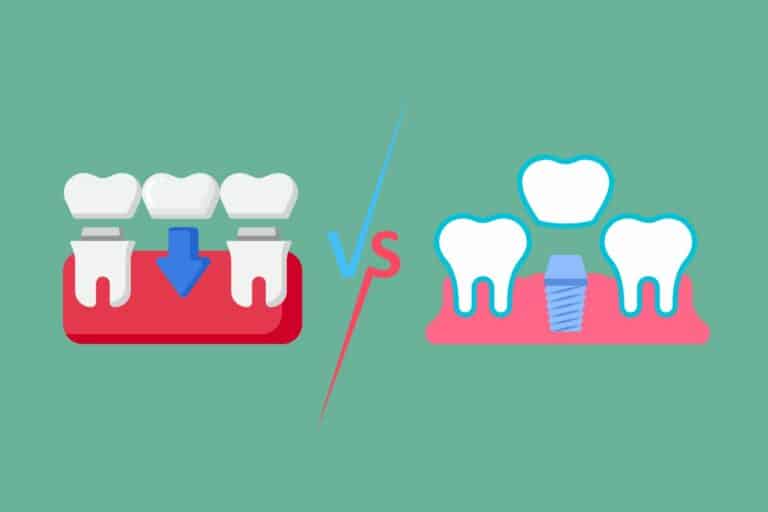 Dental Bridge Vs Implant: Which Option Is Best For You?
