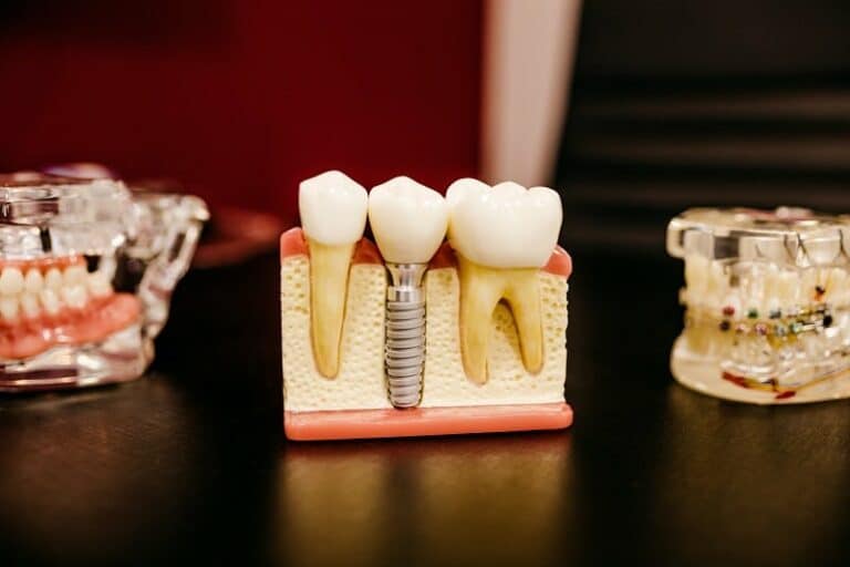 Healing After Dental Implants: What to Expect